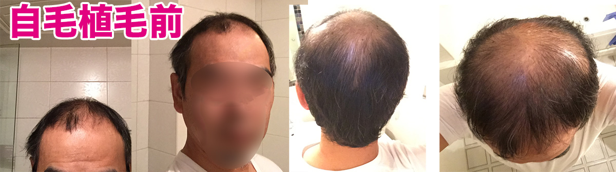 韓国で自毛植毛２８３日目 植毛の失敗と成功とは その４ の巻 毛なっしー 韓国で自毛植毛した４０代の実録ブログ